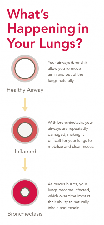 A diagram showing a healthy airway, an inflamed airway, and an airway with bronchiectasis