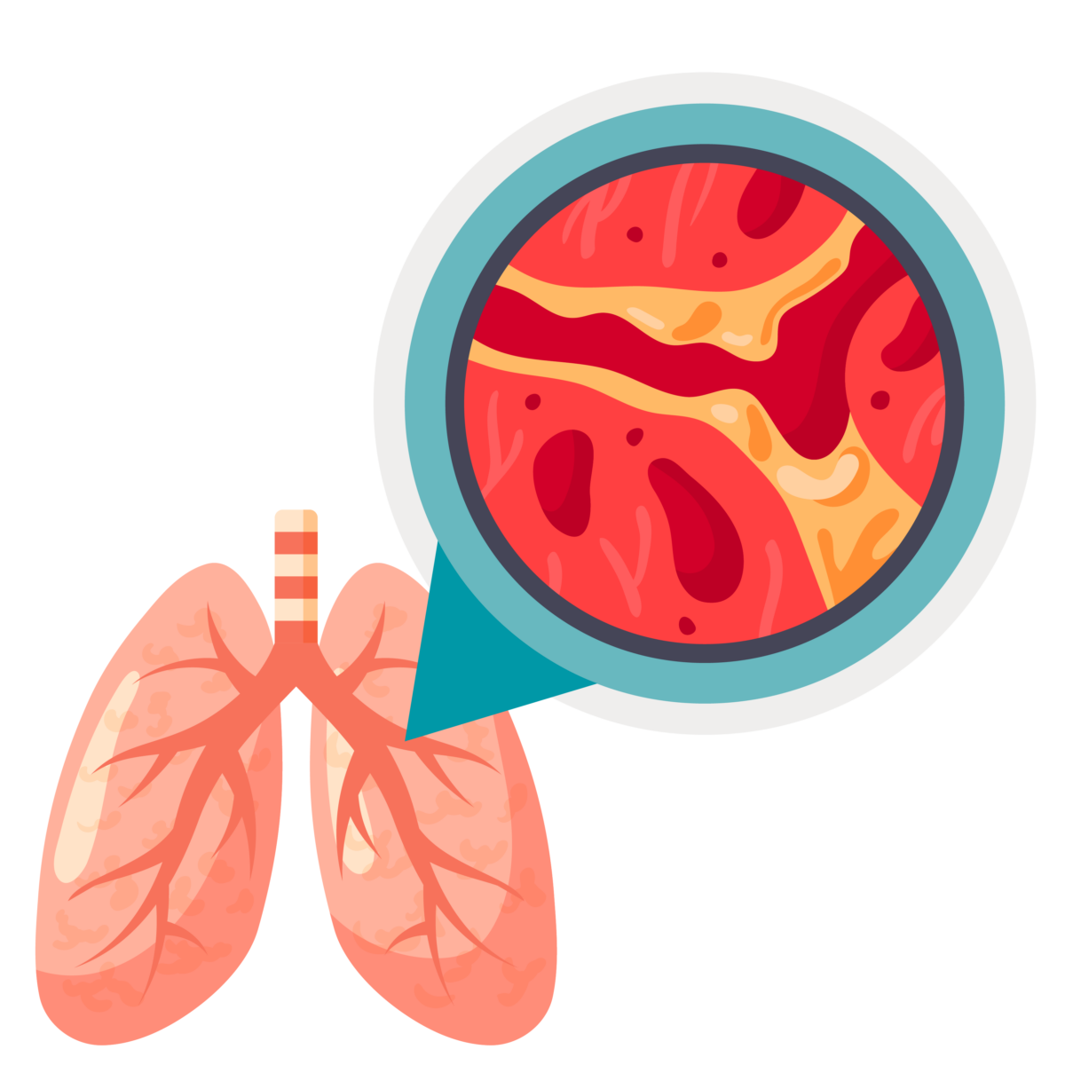 Graphic of inflamed airways.