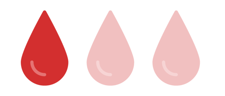 hemoptysis in bronchiectasis