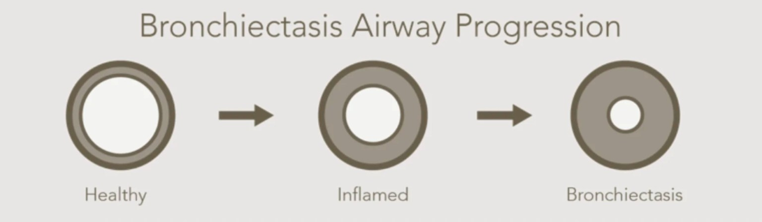 Bronchiectasis airway progression