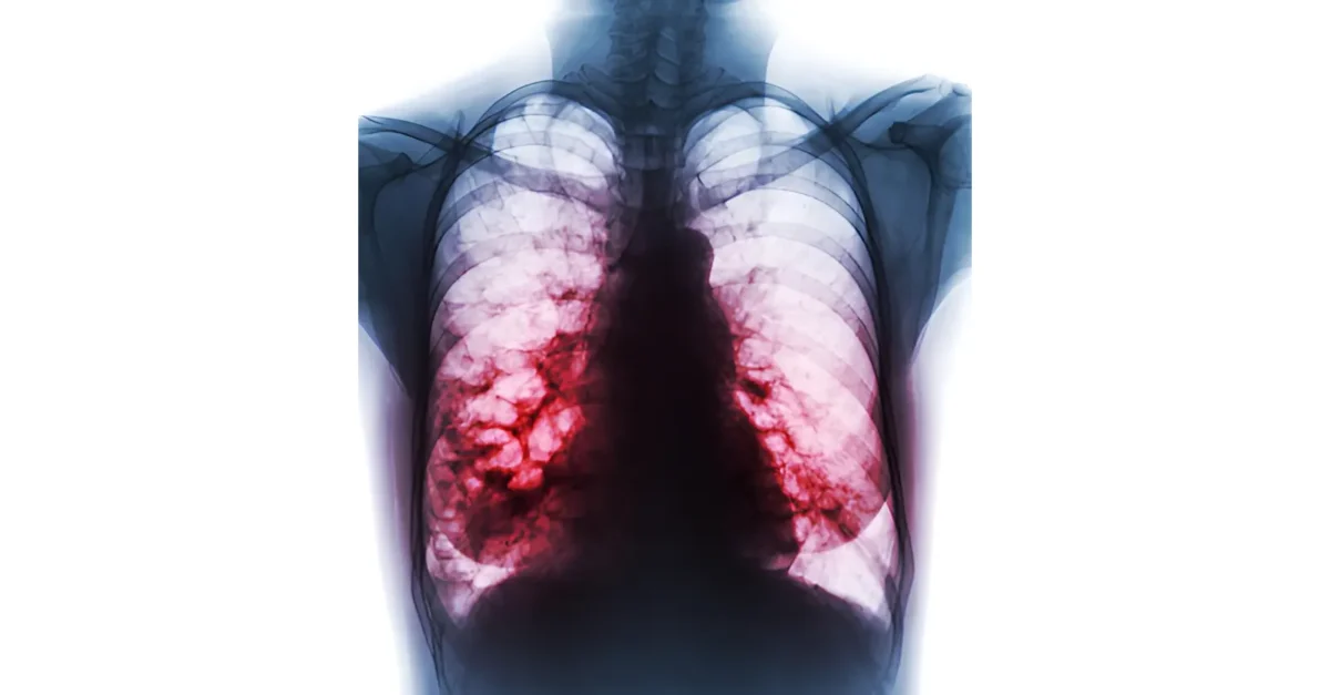 x-ray of bronchiectasis in the lungs