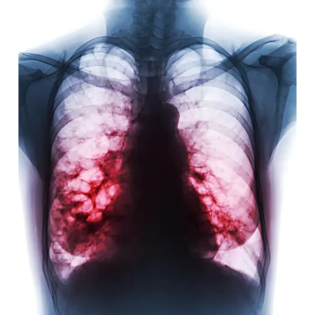 x-ray of bronchiectasis in the lungs